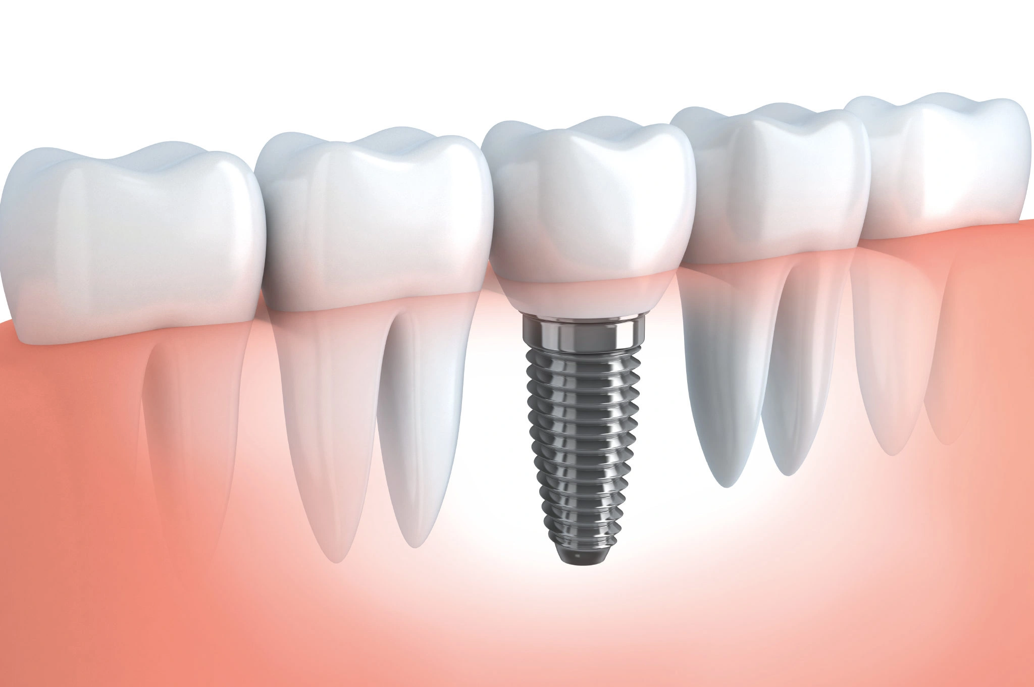 Comparing Invisalign, Veneers and Composite Bonding