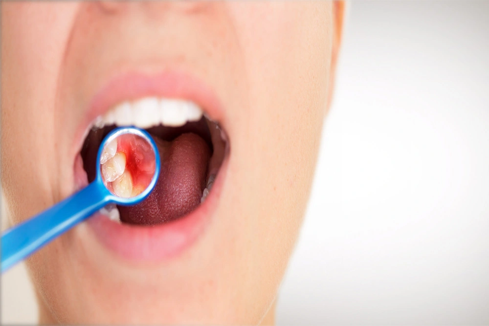 5 Preventative Methods to Reduce the Irritating Gum Diseases
