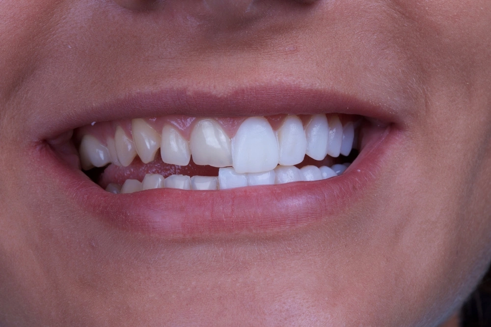 dental veneers 