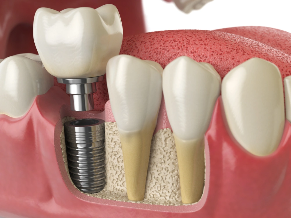 illustration of a dental implant