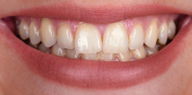 White before 2 perfectsmile