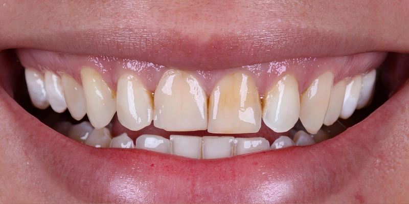 White before perfectsmile