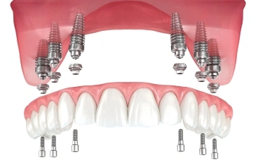 All on 6 implants
